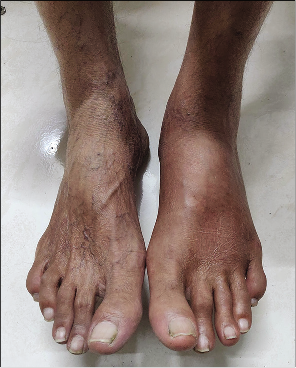 Resolved oedema of the left foot after 1 week of treatment. Source: Author’s Clinic.