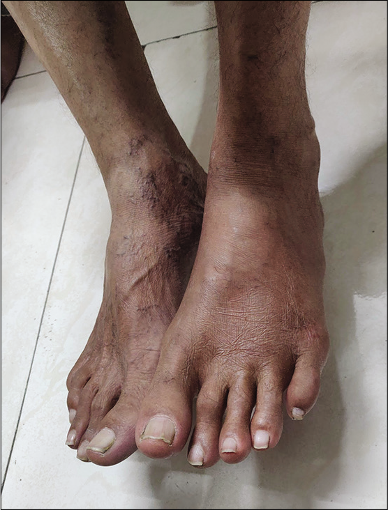 Resolved oedema of the left foot after 1 week of treatment. Source: Author’s Clinic.