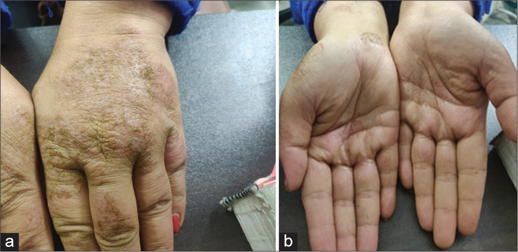 Pretreatment status of hand affected with contact dermatitis (a) denotes dorsal aspect of hand, (b) denotes palmar aspect of hand.