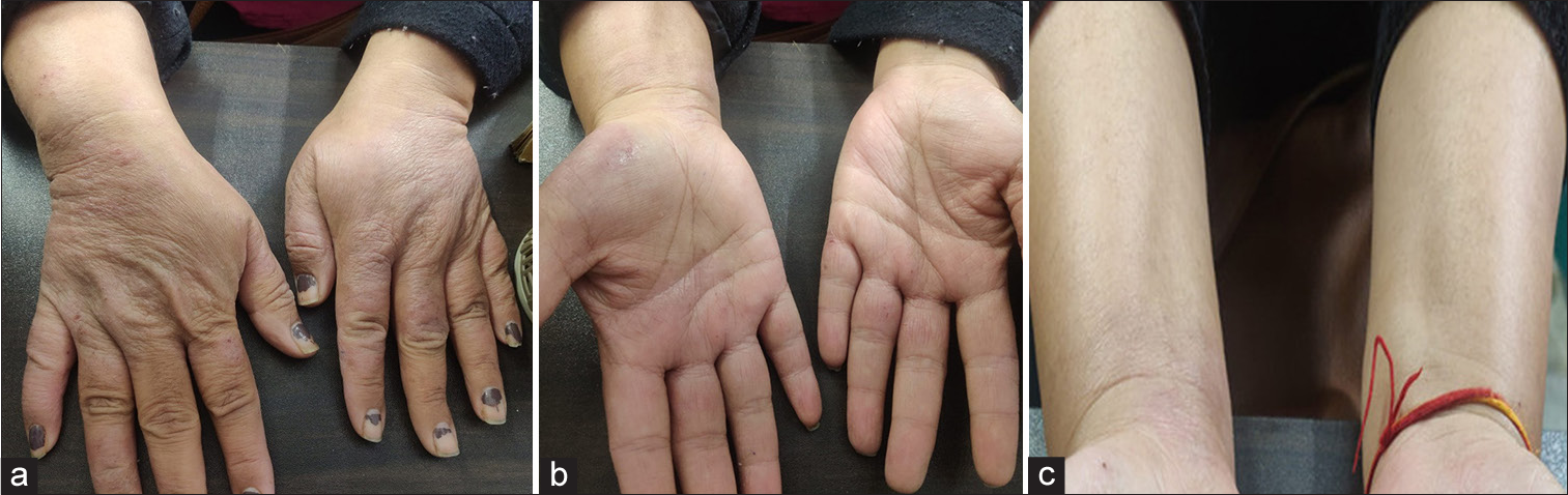 post treatment status of hand affected with contact dermatitis, (a) denotes dorsal aspect of hand, (b) denotes palmar aspect of hand, (c) denotes palmar aspect of wrist.